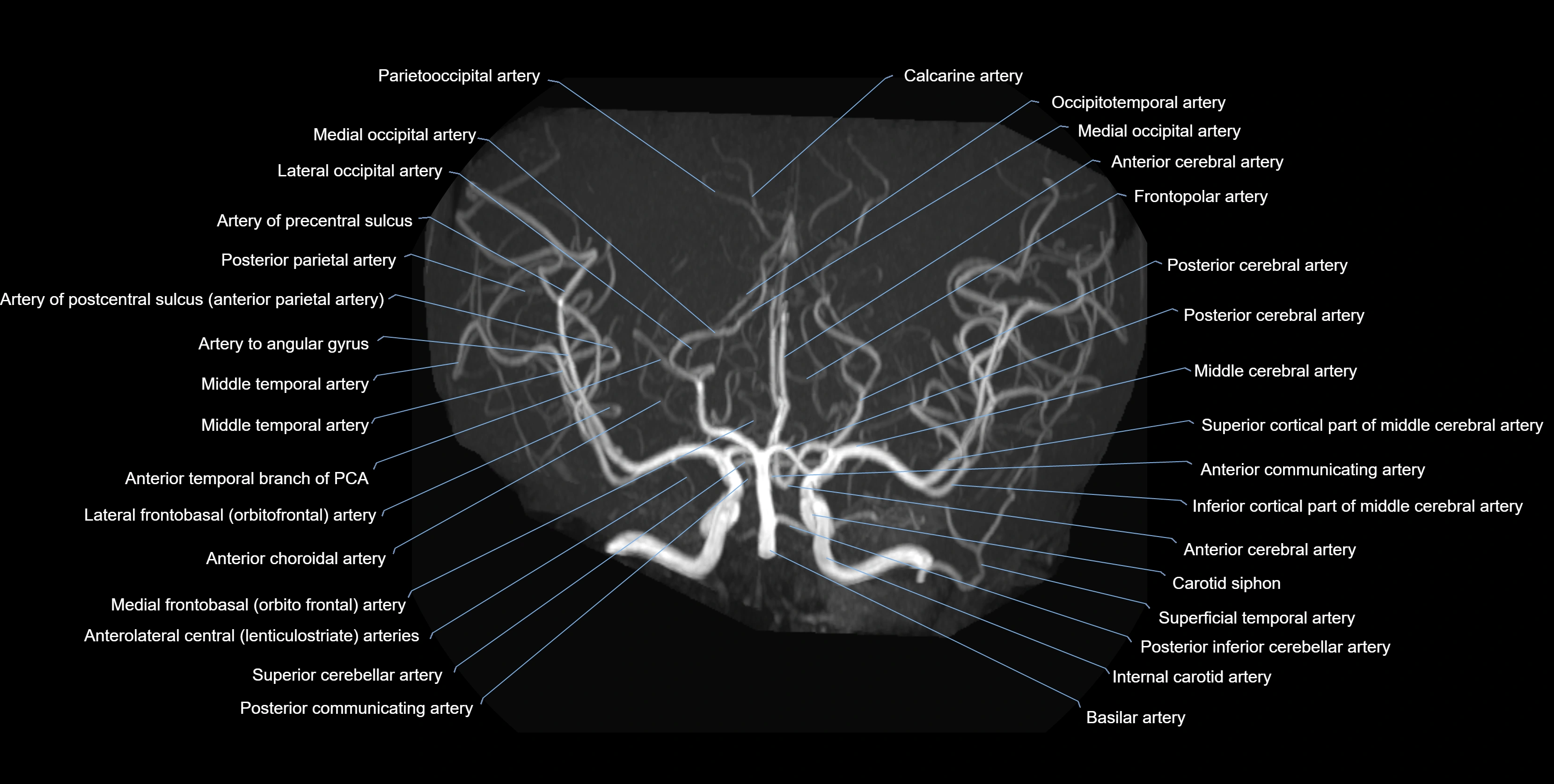 MRA brain axial MIP labelled  anatomy 3T MRI images -img-01021-00011.webp